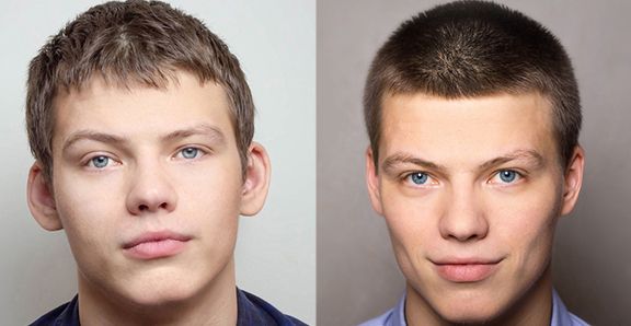 otoplastia-cordoba-candau-1-compressor (1)