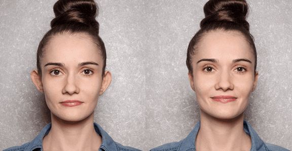 otoplastia-cordoba-candau-2-compressor